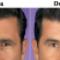 Botox