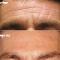 Botox