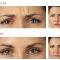 Botox