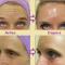 Botox
