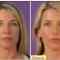 Preenchimento-facial