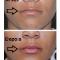 Preenchimento-labial