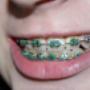 dentista osasco, dentista em osasco, implantes dentários preço, bucomaxilo em osasco, dentista preço