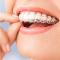 Invisalign