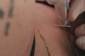 Acupuntura