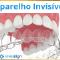 Aparelho-Invisalign