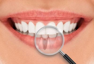 Implantes-Dentários