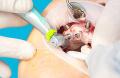 Implantes sem Corte