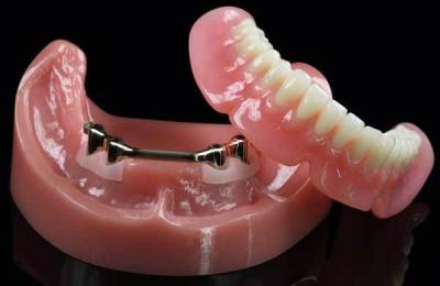 Overdenture
