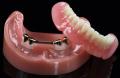 Overdenture