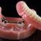 Overdenture