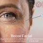 Botox facial