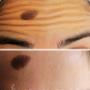 Botox