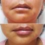 Preenchimento Labial