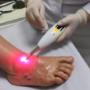 LASERTERAPIA NO TRATAMENTO DE FERIDAS