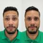 Comparação de rosto feminino em fotos de antes e depois de Botox, evidenciando redução de rugas e aparência mais jovem e descansada.