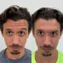 Comparação de rosto feminino em fotos de antes e depois de Botox, evidenciando redução de rugas e aparência mais jovem e descansada.