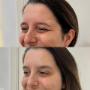 Comparação de rosto feminino em fotos de antes e depois de Botox, evidenciando redução de rugas e aparência mais jovem e descansada.