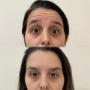Comparação de rosto feminino em fotos de antes e depois de Botox, evidenciando redução de rugas e aparência mais jovem e descansada.