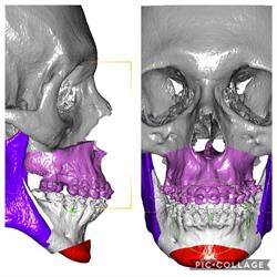 Simetria Facial- Cirurgia Ortognática