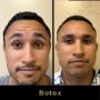 Botox