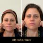 ultraformeer