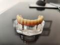 Implantes
