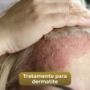 Terapia Capilar