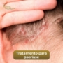 Terapia Capilar