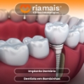 Implante dentário