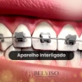 Aparelho Ortodontico