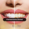 Clareamento Dental