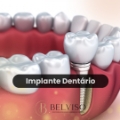 Implante Dentário