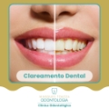 Clareamento Dentário