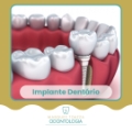Implante Dentário