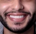 Facetas em resina composta