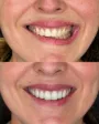 Lentes de contato dental
