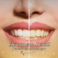 Clareamento Dental