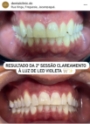 CLareamento Dentário