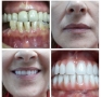 Implante dentário fixo