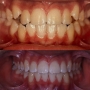 Antes e Depois do Aparelho Dentario