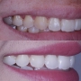 Clareamento Dental