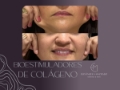Bioestimuladores de Colágeno