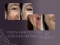 Preenchimento com Ácido Hialurônico