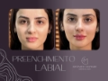 preenchimento labial viçosa-harmonização labios viçosa