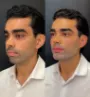 Harmonização facial em Fortaleza - Antes e depois 5.jpg