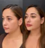 Harmonização facial em Fortaleza - Antes e depois 1.jpg