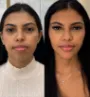 Harmonização facial em Fortaleza ceará 1.jpg