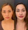 Harmonização facial em Fortaleza - Antes e depois 2.jpg
