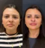 Caso real - harmonização facial em Fortaleza 4.jpg